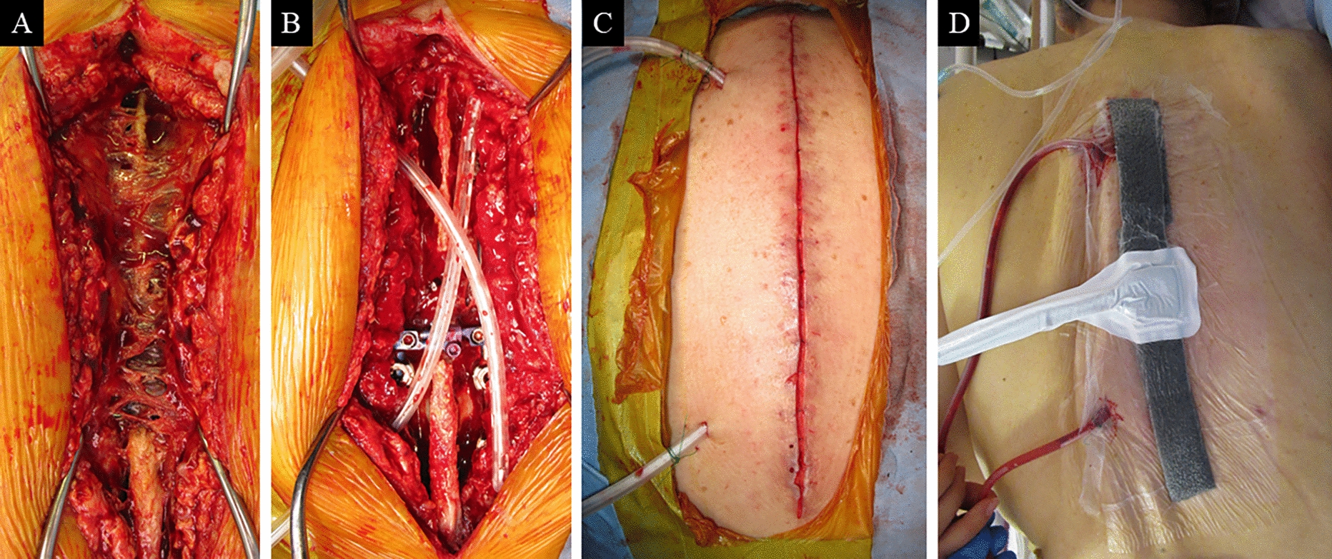 Efficacy and Limitations of Continuous Local Antibiotic Perfusion in Treating Surgical Site Infections Following Instrumented Spinal Surgery: A Retrospective Multicenter Study