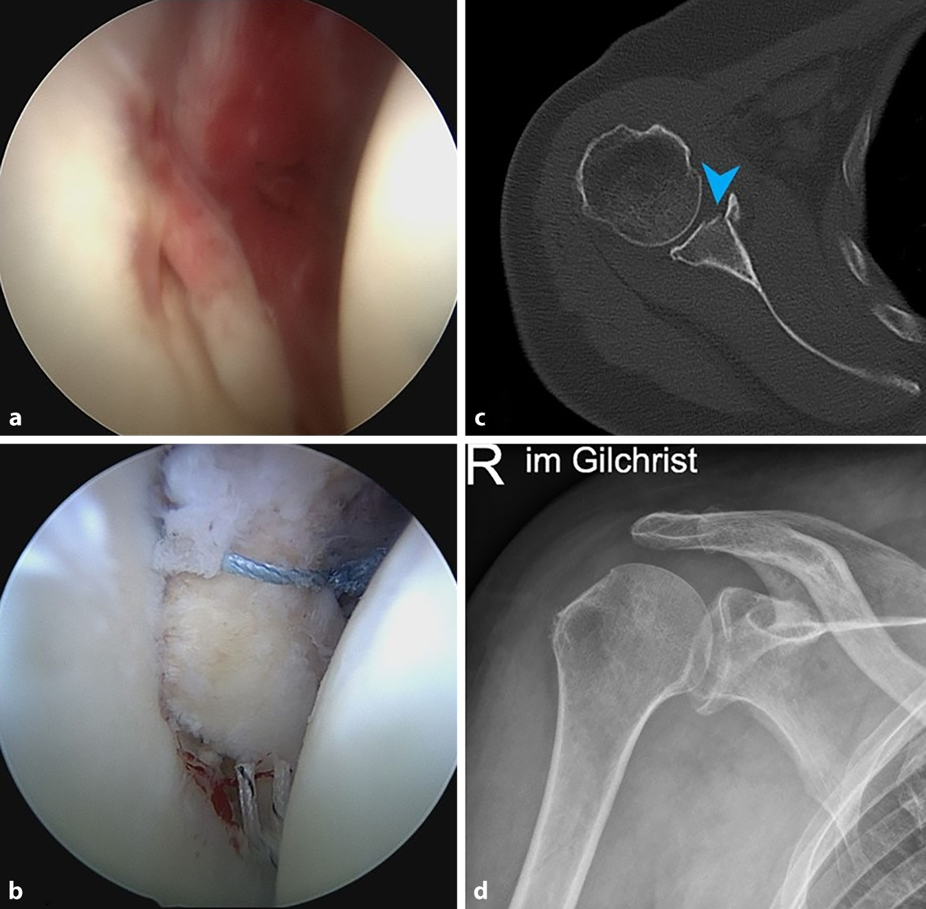 Iatrogenic injury of the axillary artery as a complication of a bony Bankart repair following traumatic anterior shoulder dislocation—a case report