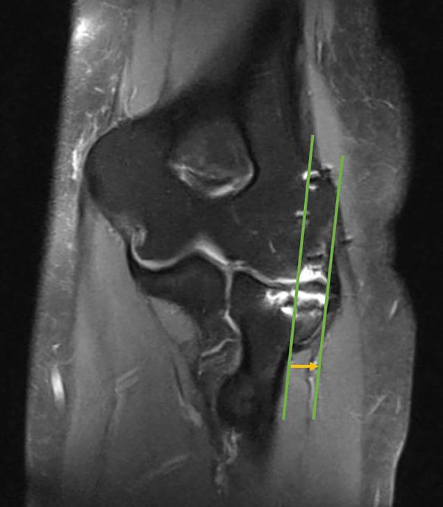 Radial head deformity as an osseous cause of recurrent posterolateral elbow instability—a case report