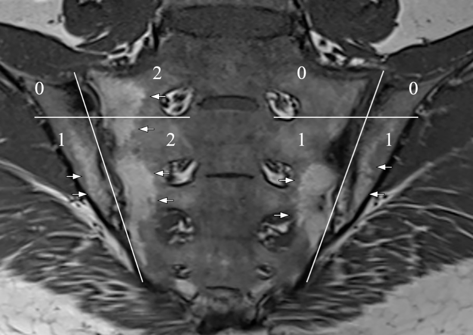 The serum level of sclerostin decreases in radiographic axial spondyloarthritis patients with fatty lesions