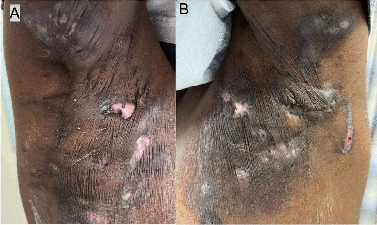 The Use of Complementary and Alternative Medicine in Management of Hidradenitis Suppurativa