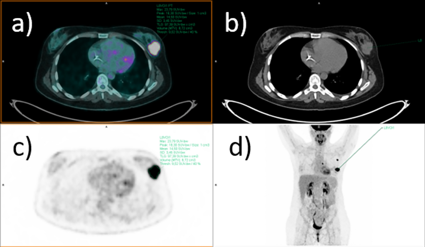 18F-FDG PET/CT radiomic analysis and artificial intelligence to predict pathological complete response after neoadjuvant chemotherapy in breast cancer patients