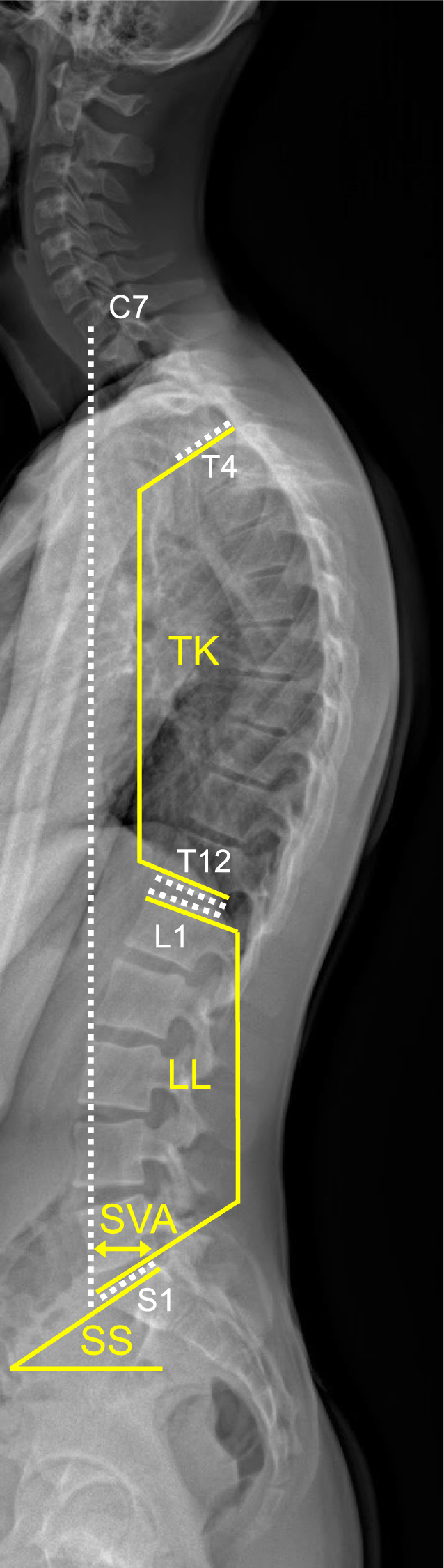 Automated spinopelvic measurements on radiographs with artificial intelligence: a multi-reader study