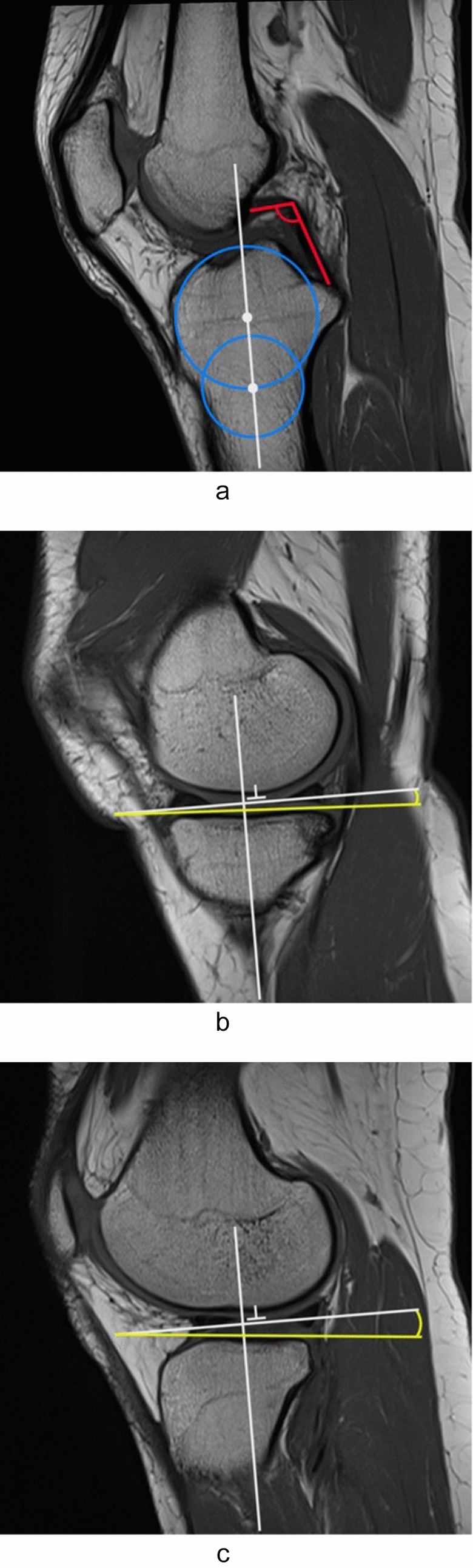 The posterior cruciate ligament angle in the setting of anterior cruciate ligament deficient knees: the effect of gender, age, time from injury and tibial slope