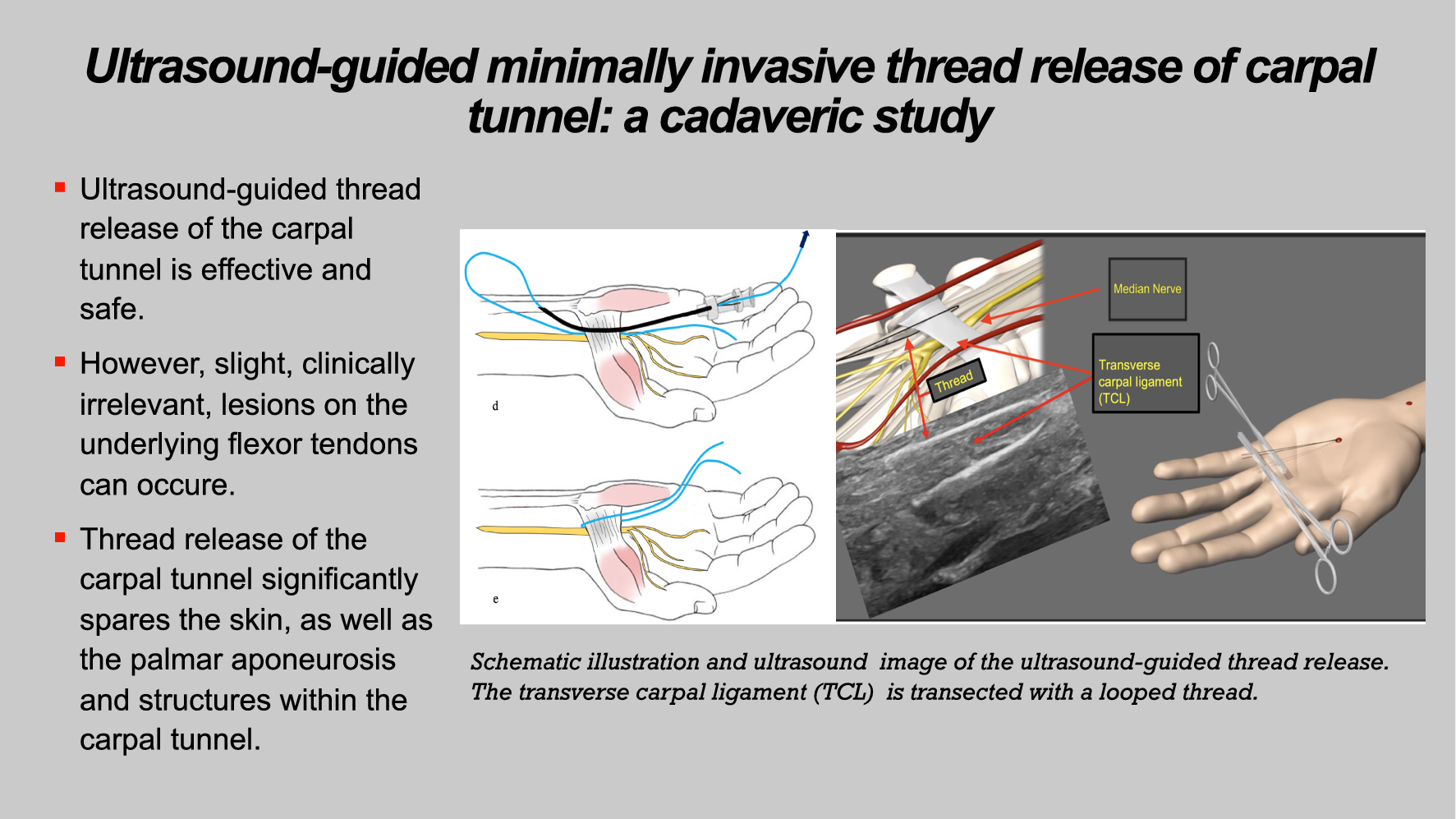 Ultrasound-guided minimally invasive thread release of carpal tunnel: a cadaveric study