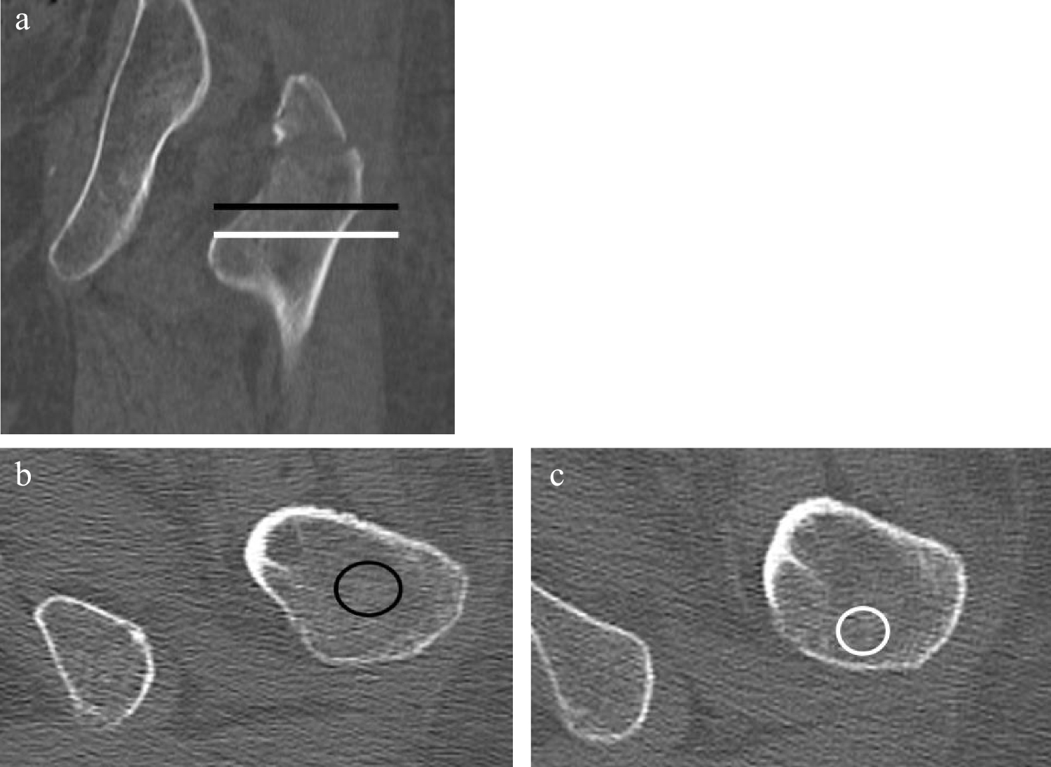 Quantitative ROI differences for assessment of occult intertrochanteric extension of greater trochanteric fractures on pelvis CT