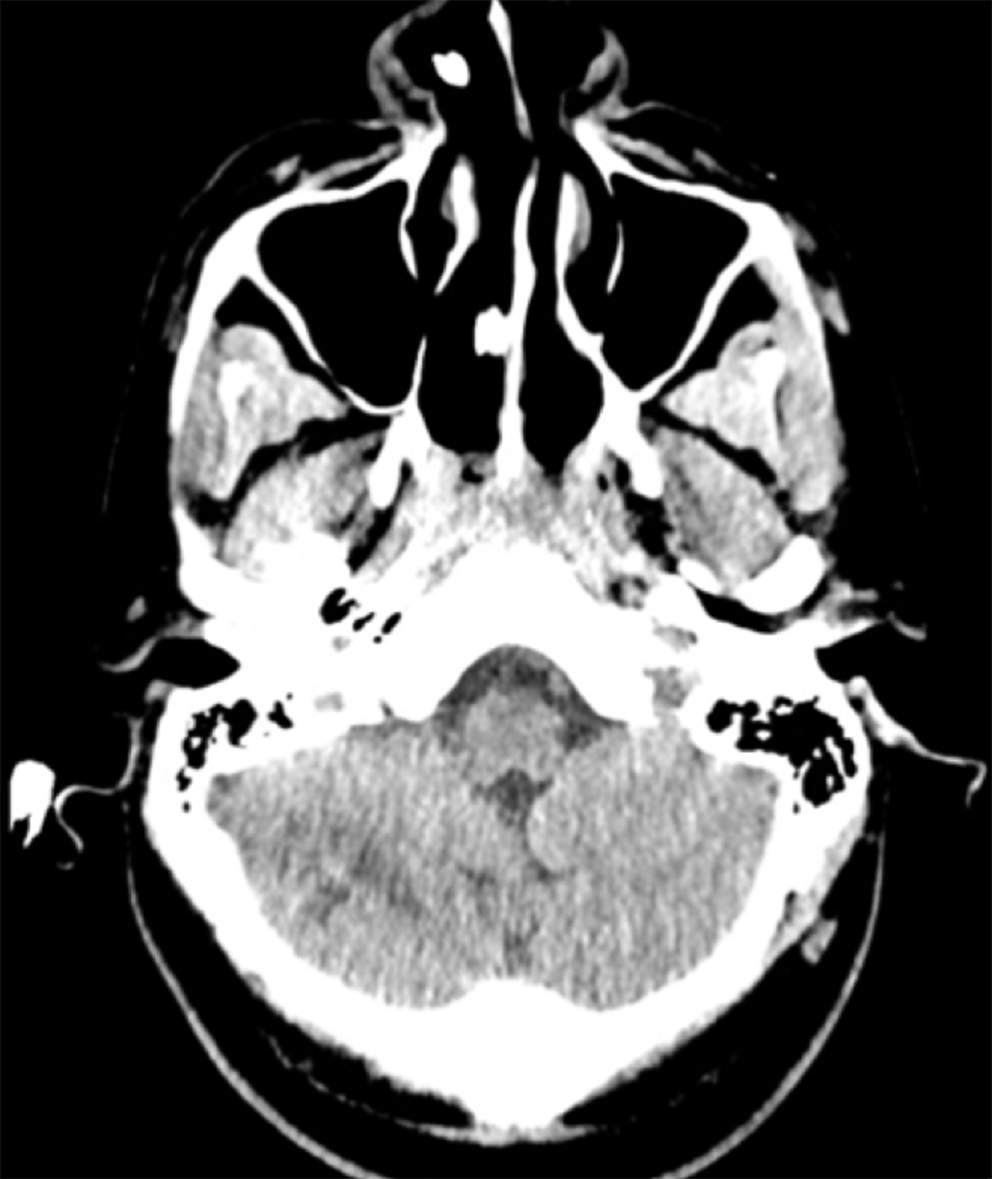 Brain microbleeds resulting from presumed extensive fat emboli in a patient with bone marrow necrosis following a sickle cell disease vaso-occlusive crisis