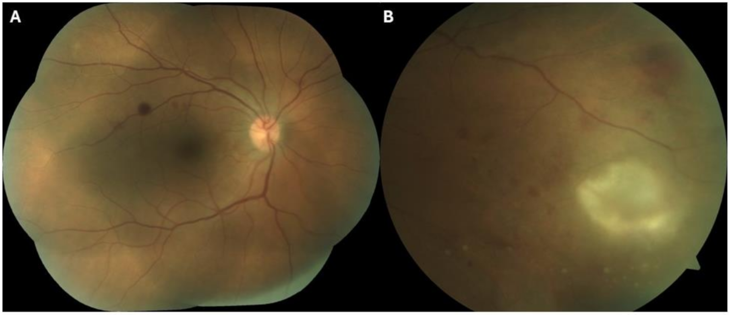 Retinitis linked to human herpesvirus type 6: a case study in a splenectomised patient