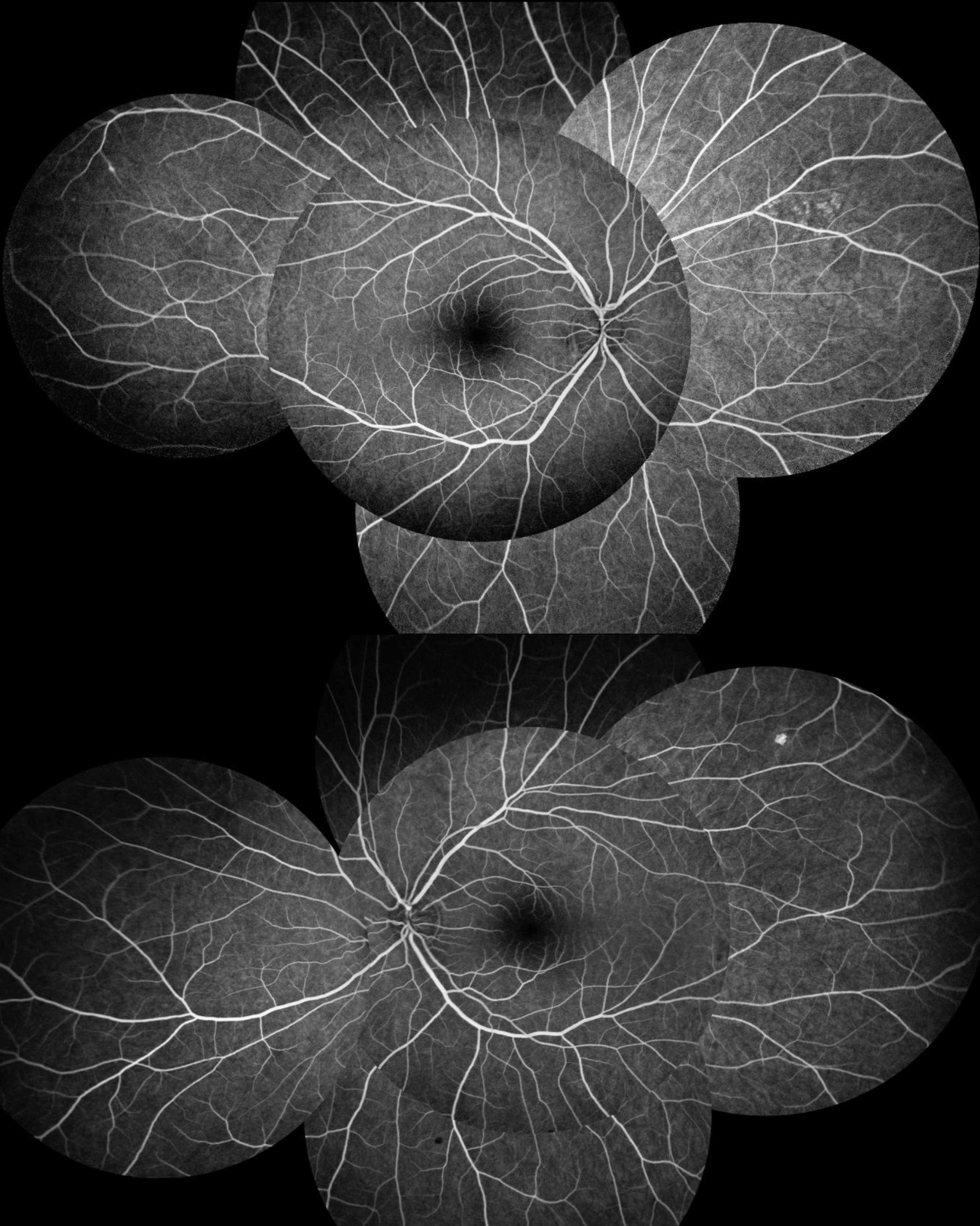 Acute macular neuroretinopathy occurrence in a Behçet disease patient: a case report