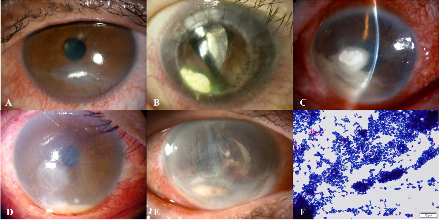 Clinical and bacteriological characteristics of Corynebacterium keratitis