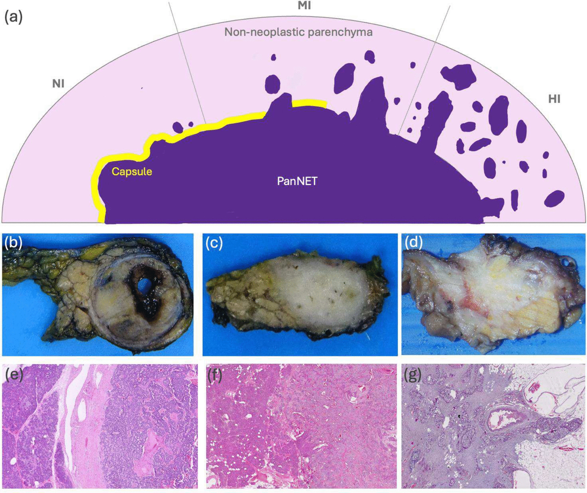 Deep Learning Enabled Scoring of Pancreatic Neuroendocrine Tumors Based on Cancer Infiltration Patterns