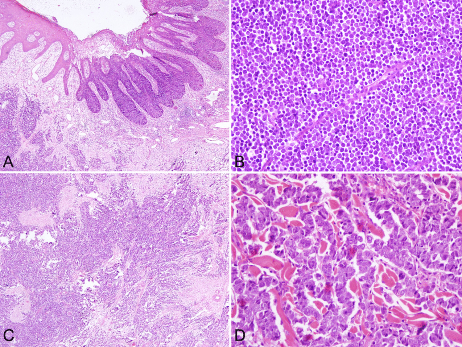 Evaluating CK20 and MCPyV Antibody Clones in Diagnosing Merkel Cell Carcinoma