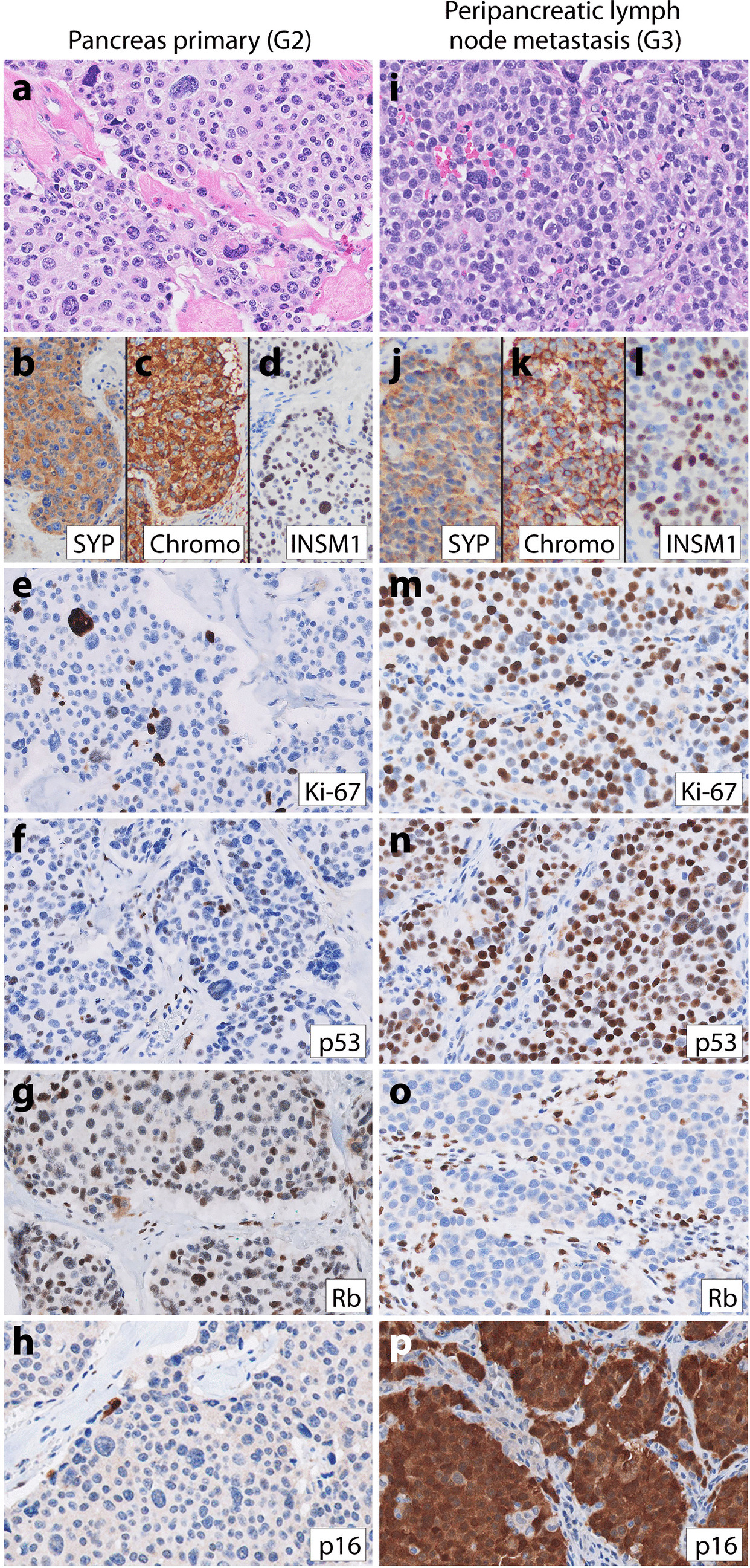 Progression of Low-Grade Neuroendocrine Tumors (NET) to High-Grade Neoplasms Harboring the NEC-Like Co-alteration of RB1 and TP53