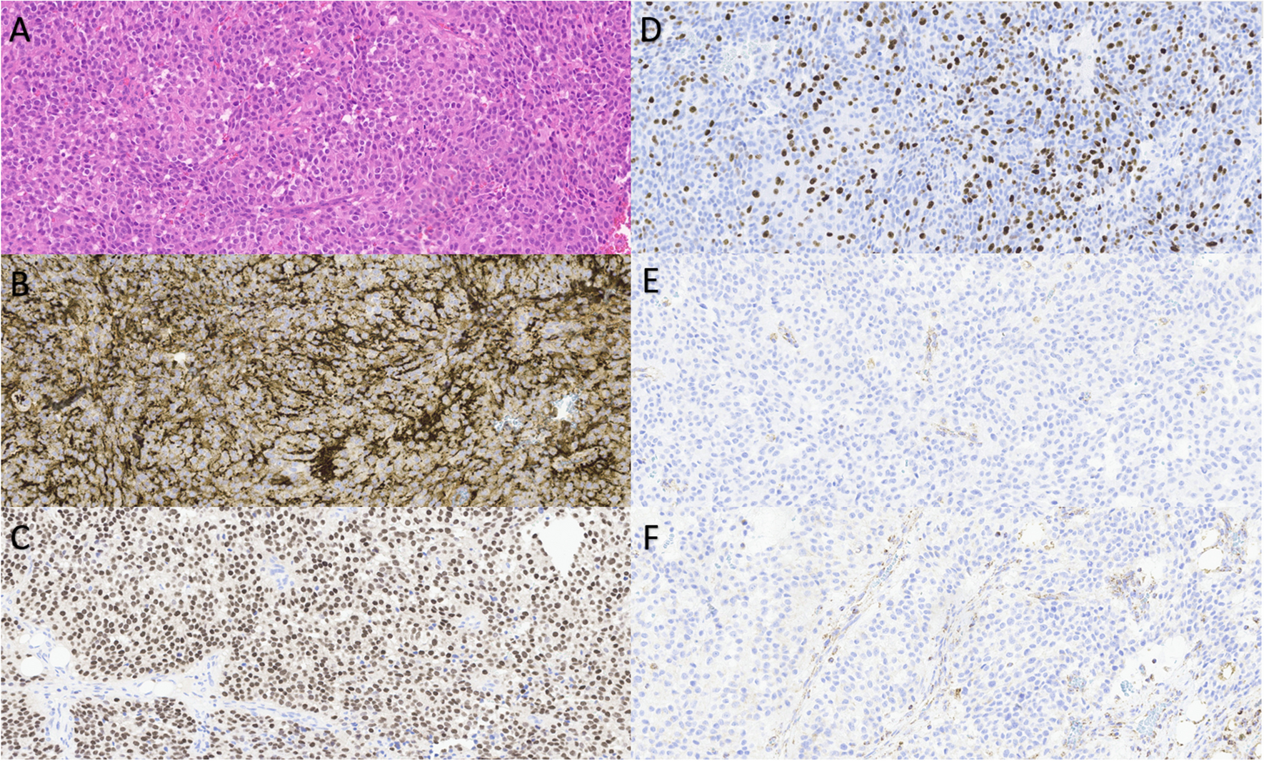 The Molecular Classification of Pheochromocytomas and Paragangliomas: Discovering the Genomic and Immune Landscape of Metastatic Disease