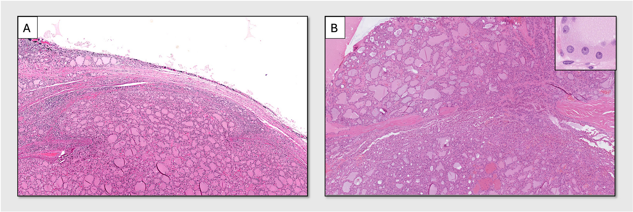 Catching the Silent Culprits: TERT Promoter Mutation Screening of Minimally Invasive Follicular and Oncocytic Thyroid Carcinoma in Clinical Practice