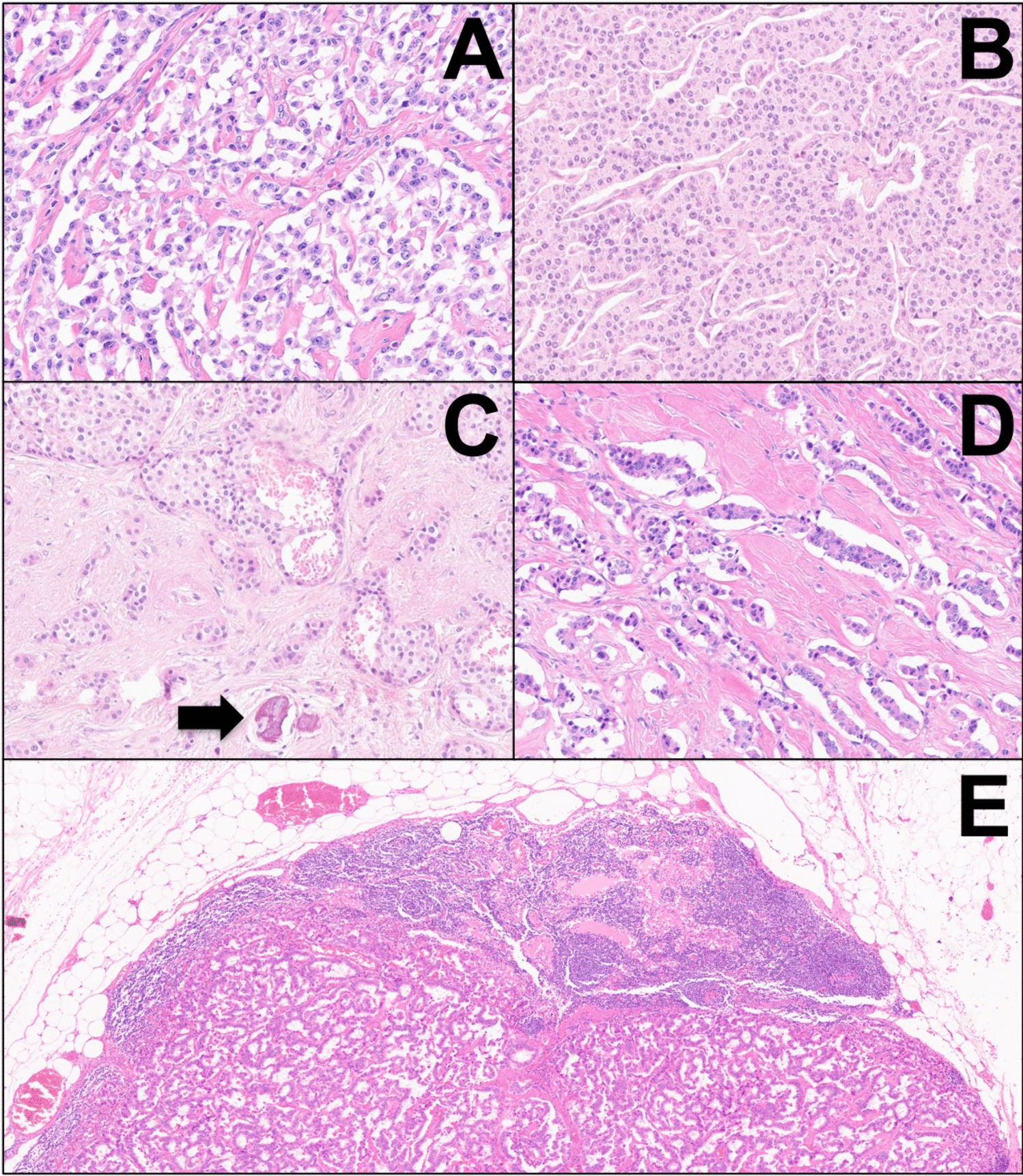 Glucagon-Producing Pancreatic Neuroendocrine Tumors (Glucagonomas) are Enriched in Aggressive Neoplasms with ARX and PDX1 Co-expression, DAXX/ATRX Mutations, and ALT (Alternative Lengthening of Telomeres)