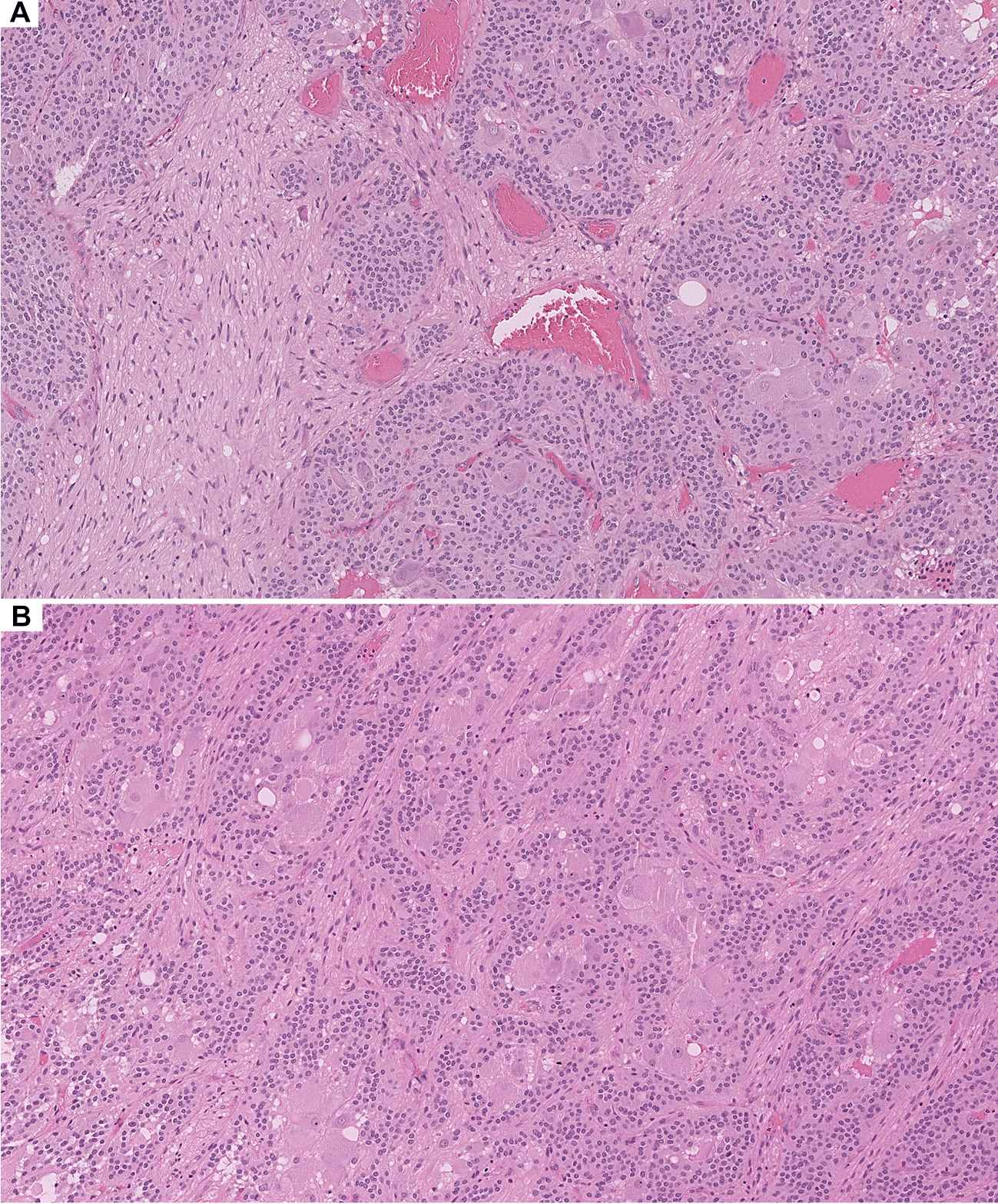 Cauda Equina Neuroendocrine Tumors with Ganglioneuromatous Elements are Best Classified as Composite Gangliocytoma/Neuroma and Neuroendocrine Tumor (COGNET)