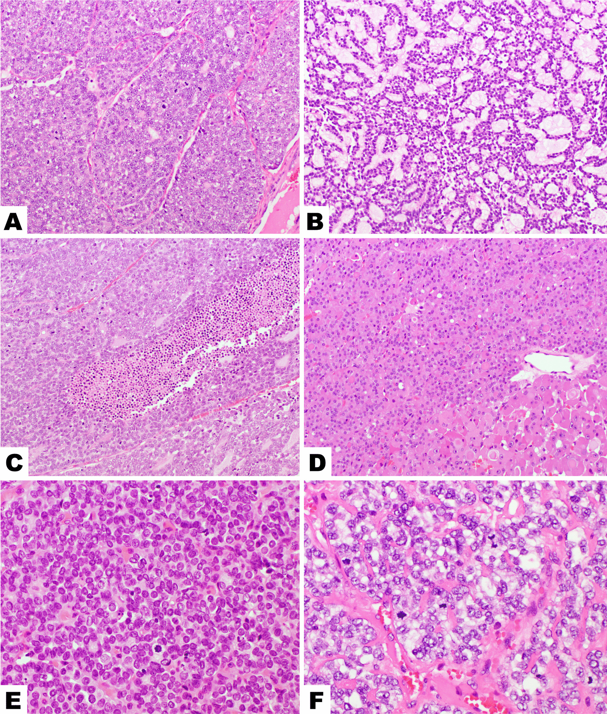 Clinicopathologic and Molecular Analysis of 15 Pediatric and Young Adult Patients with High-Grade Non-anaplastic Thyroid Carcinoma