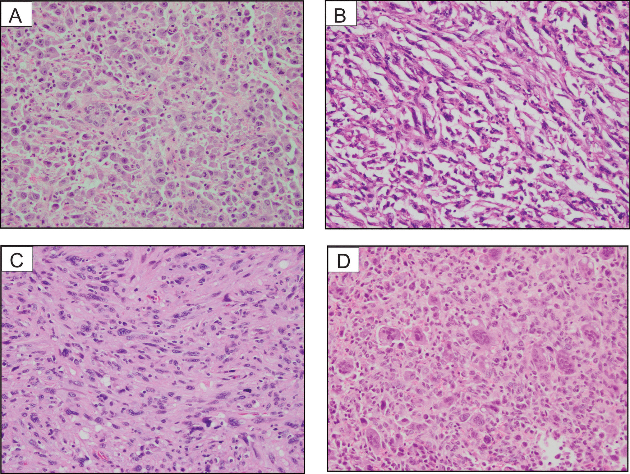 SATB2 is an Emergent Biomarker of Anaplastic Thyroid Carcinoma: A Series with Comprehensive Biomarker and Molecular Studies