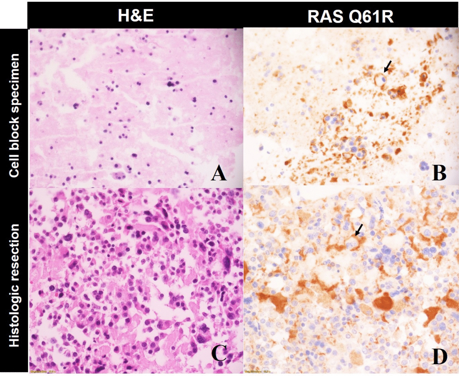 The Potential Utility of RAS Q61R Immunohistochemistry as a Screening Tool in Pre-operative Fine Needle Aspirates of Medullary Thyroid Carcinoma