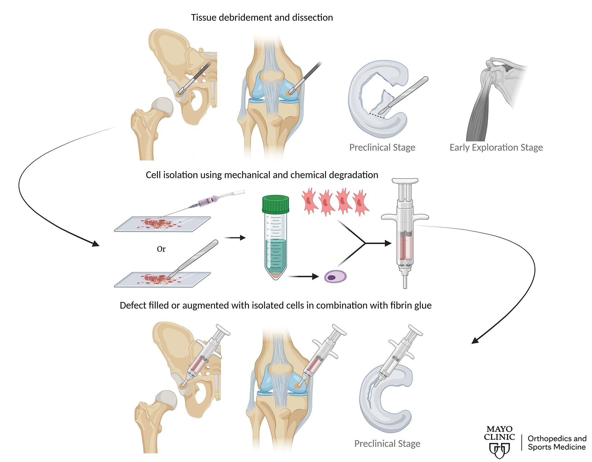 From IMPACT to RECLAIM: A Single-Stage Cell Therapy for Articular Cartilage Repair and a Platform for Musculoskeletal Tissue Regeneration