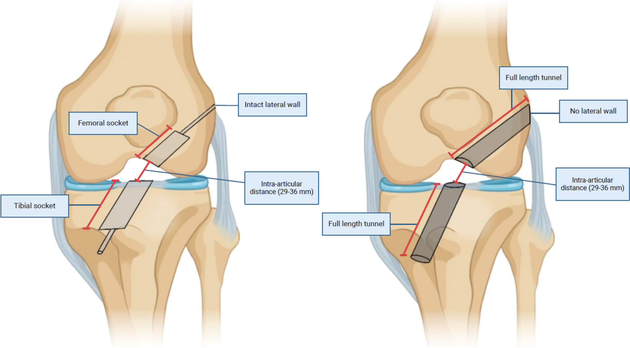 Anterior Cruciate Ligament Reconstruction: Common Intraoperative Mistakes and Techniques for Error Recovery