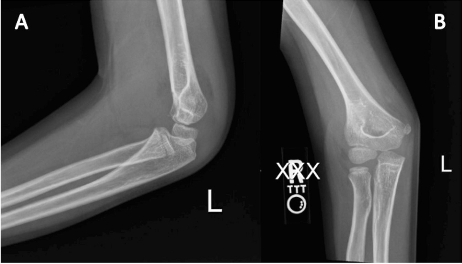 Nonoperative Management of Gartland Type II Supracondylar Humeral Fractures: A Comprehensive Review