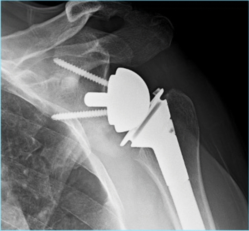 Navigating the Complexities of Range of Motion in Reverse Shoulder Arthroplasty: Innovations and Future Directions