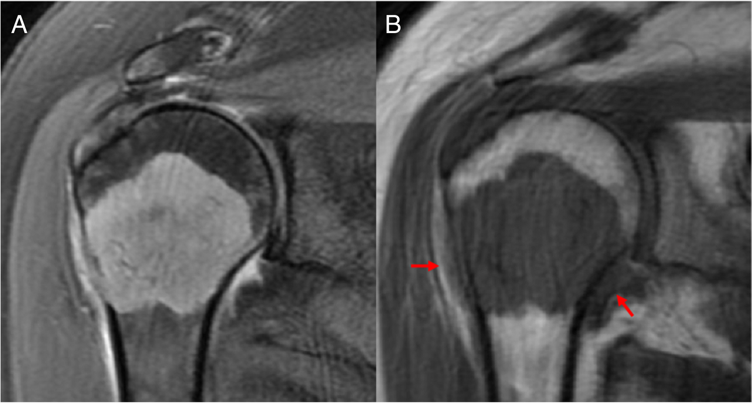 Endoprosthetic Reconstruction for Proximal Humerus Tumors