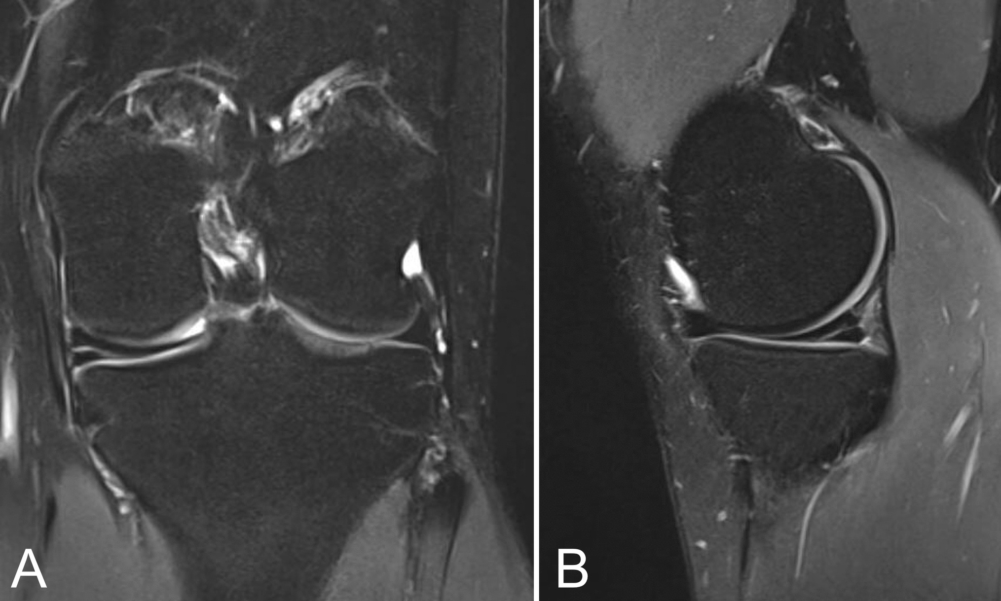 Management of Horizontal Cleavage Meniscus Tears