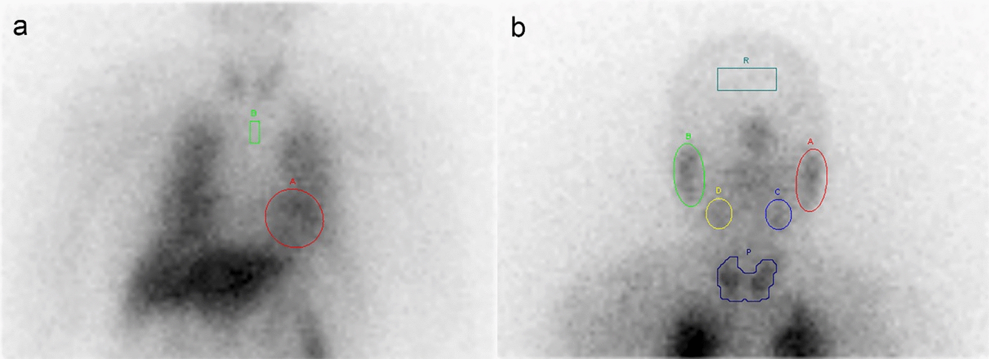 Value of multi-parameter 123I-MIBG scintigraphy in the differential diagnosis of Parkinson’s disease