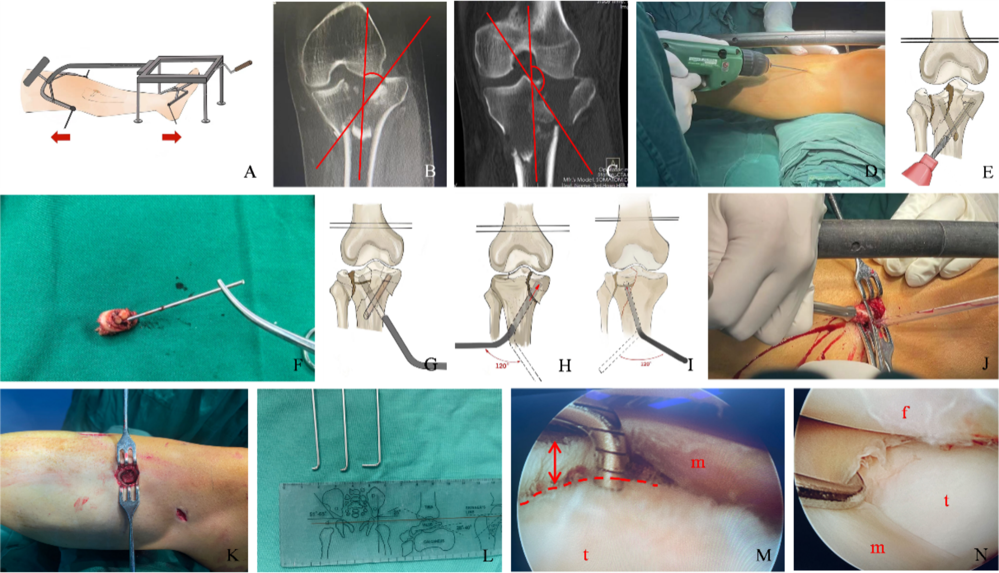 A novel minimally invasive technique for the treatment of tibial plateau collapse fracture: radiological and arthroscopic evaluation