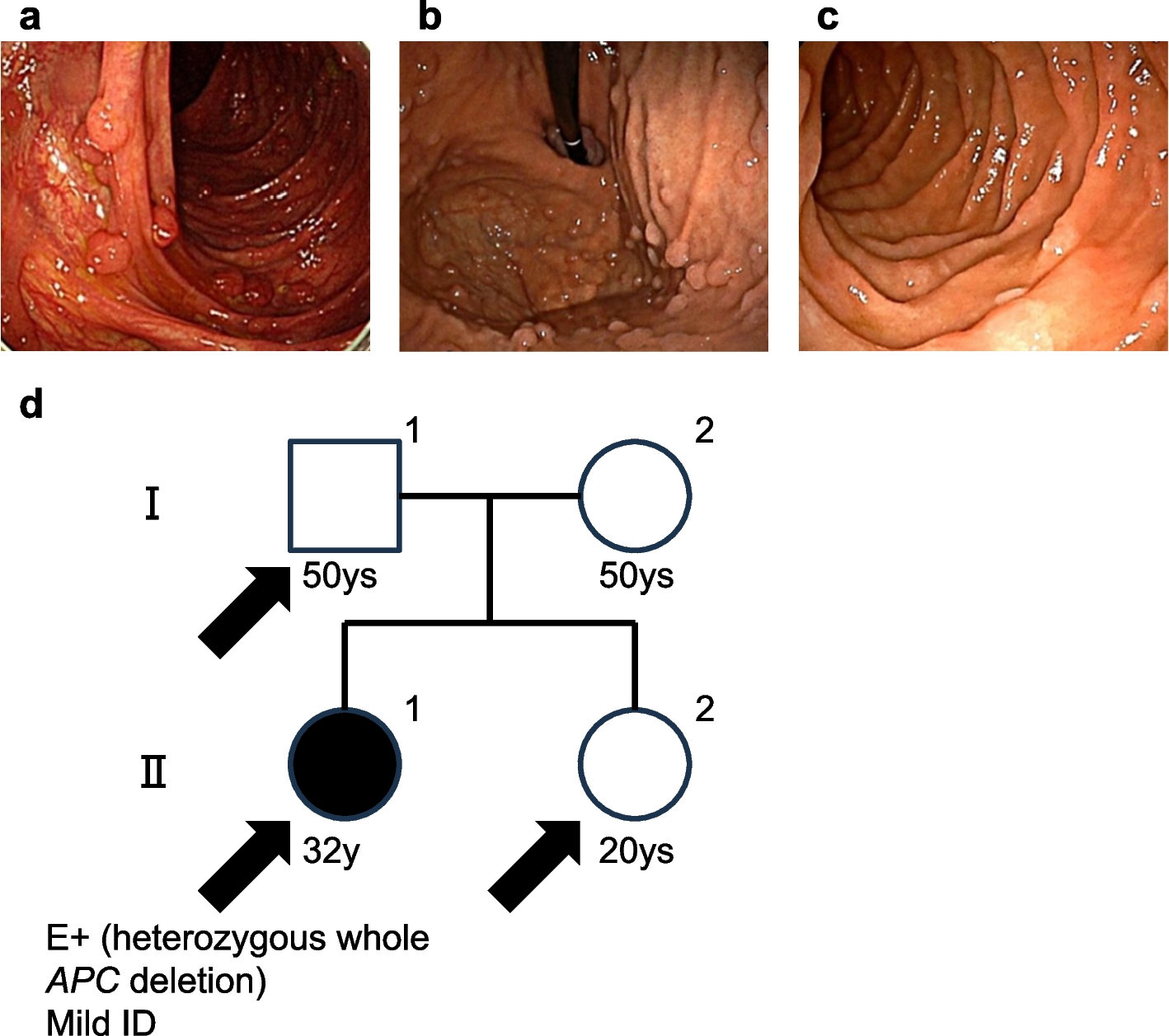 Two independent families with de novo whole APC gene deletion and intellectual disability: a case report