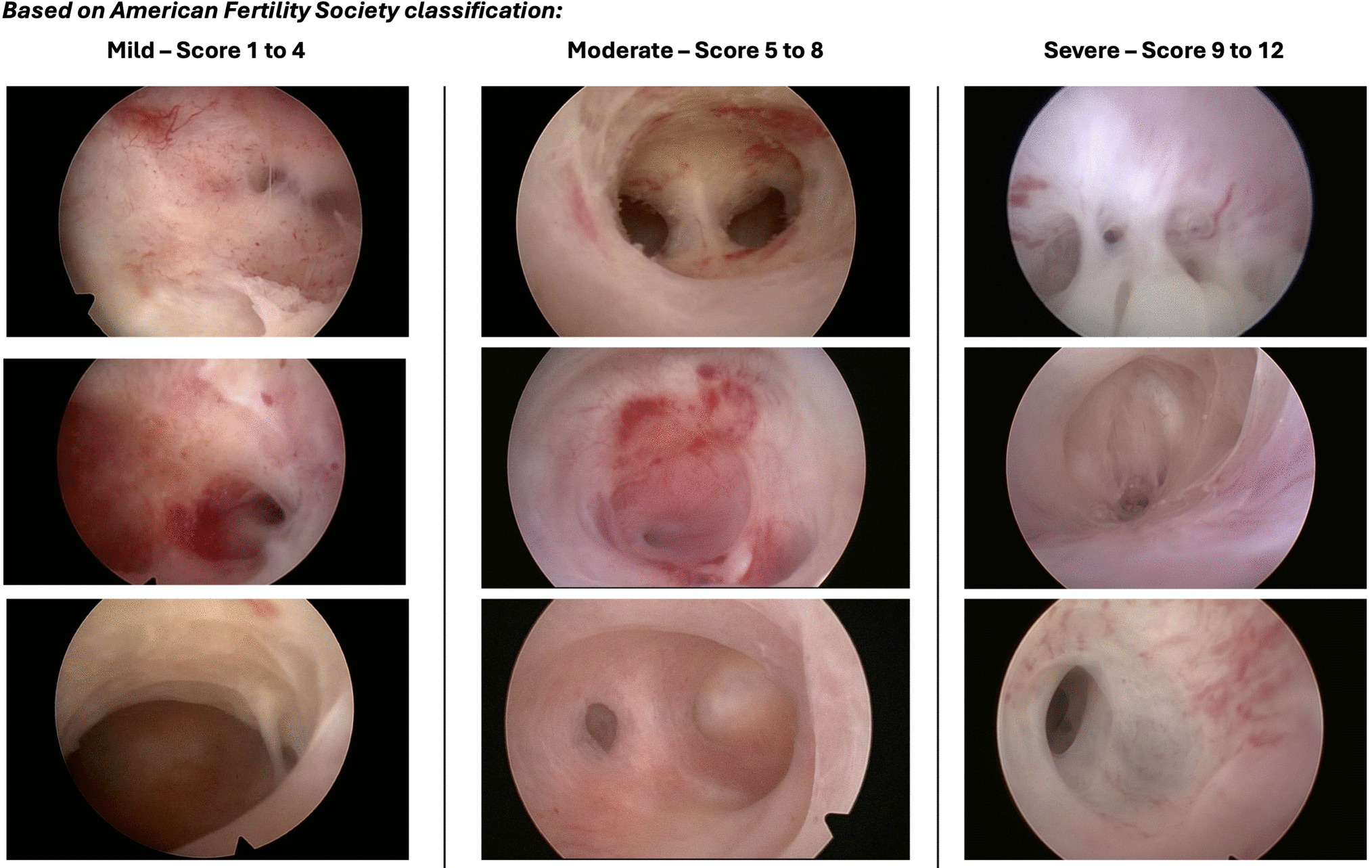 Asherman Syndrome: An Updated Review on Diagnosis, Management, and Pregnancy Outcomes