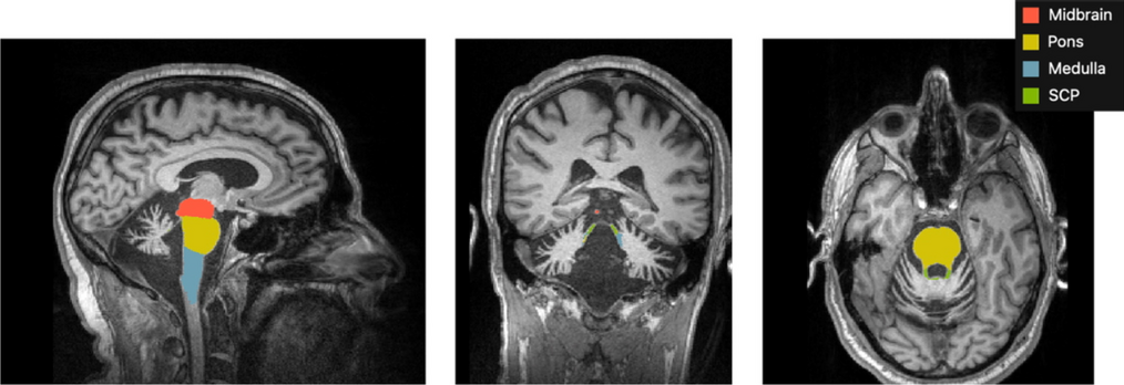 Brainstem Substructure Atrophy in Late-Onset GM2-Gangliosidosis Imaging Using Automated Segmentation