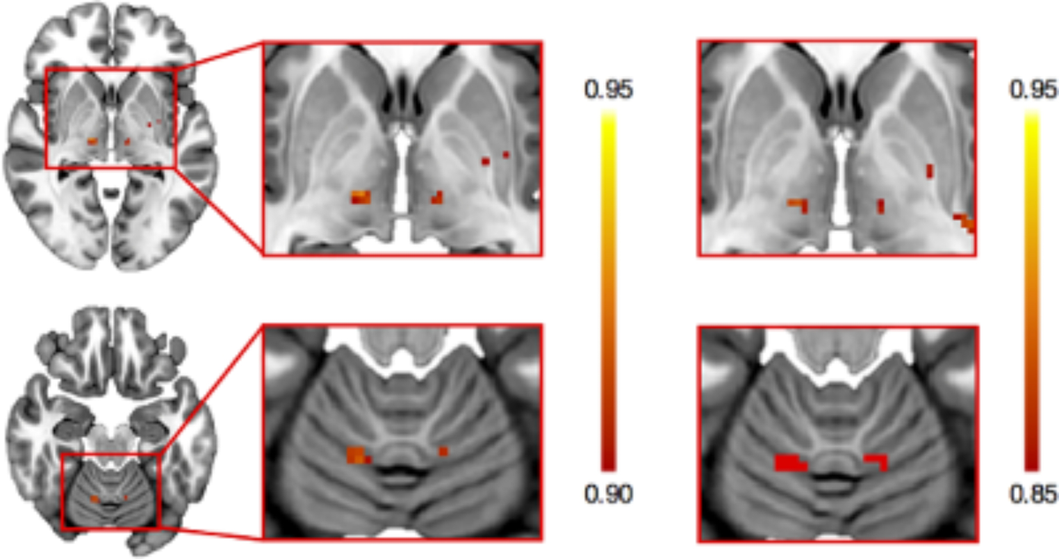 Emerging Deep Brain Stimulation Targets in the Cerebellum for Tremor