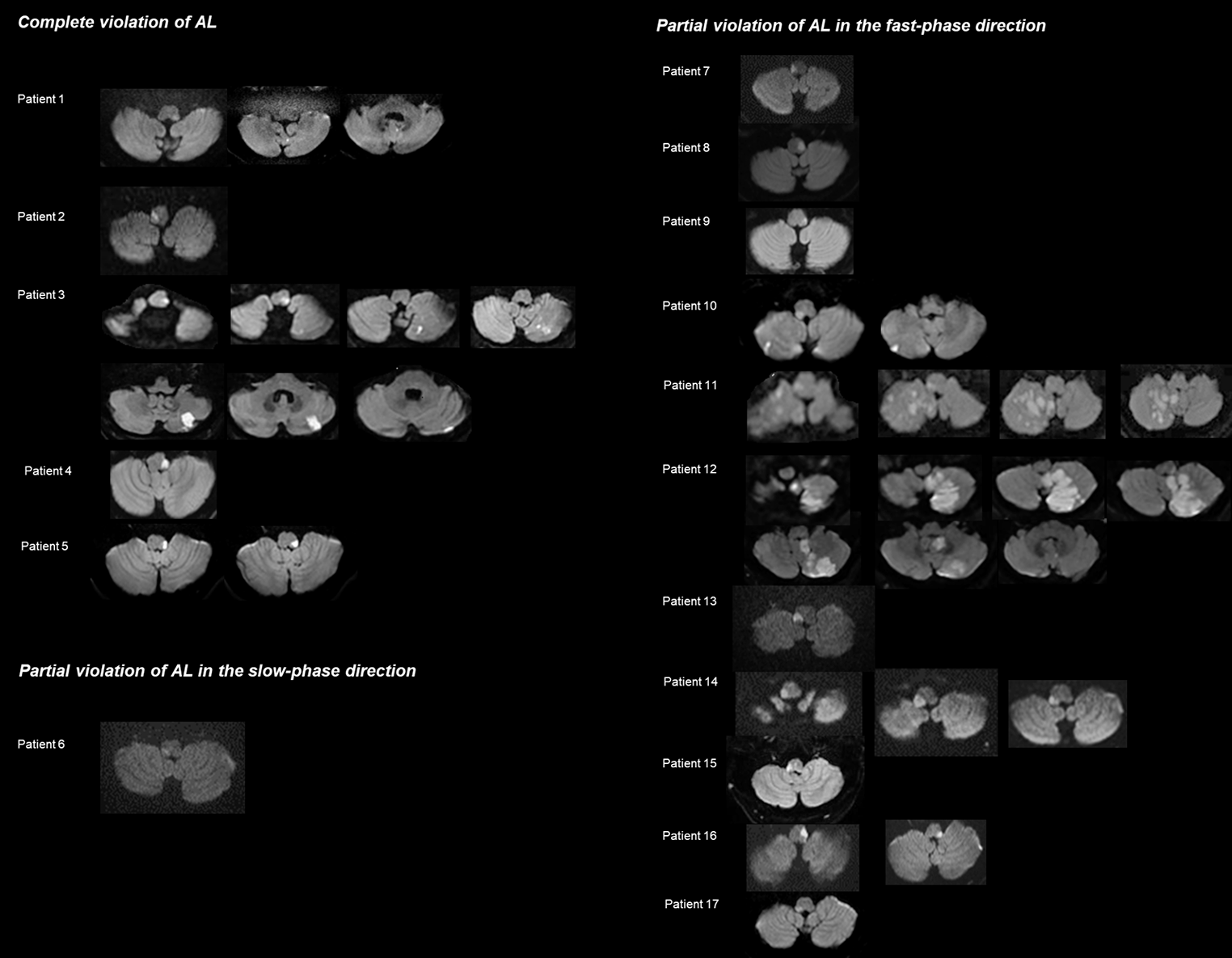 Spontaneous Nystagmus Violating the Alexander’s Law: Neural Substrates and Mechanisms