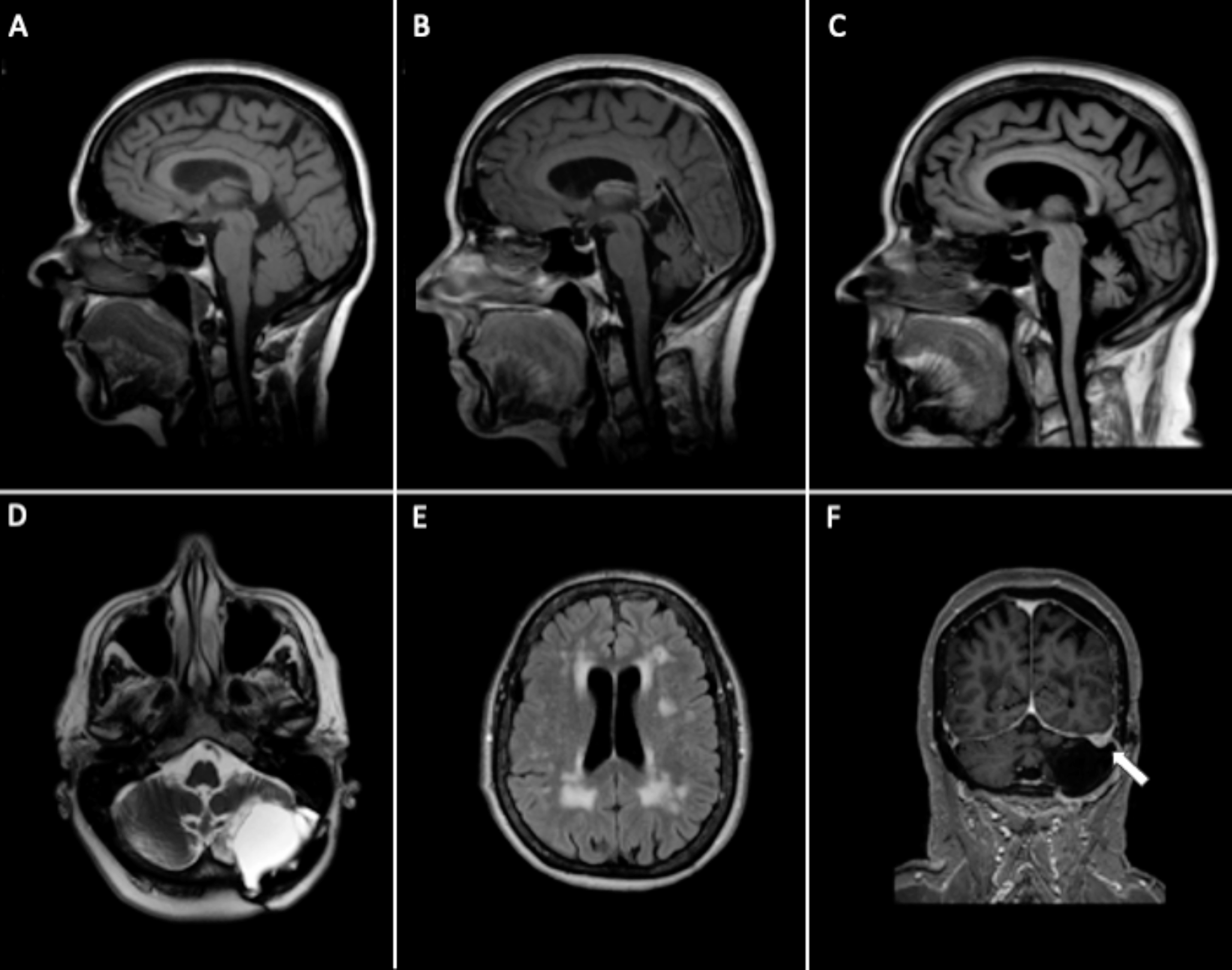 Delayed Progression of Ataxia with a Static Cerebellar Lesion– Consider SCA27B