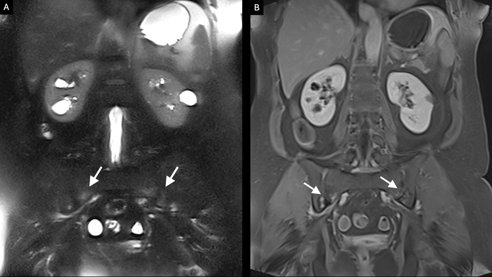 Arthralgia and Extraintestinal Manifestations in Crohn’s Disease Elevate the Risk of IBD-Related Arthritis over Sacroiliitis