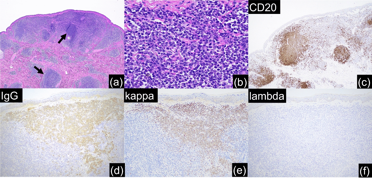 New classifications of B-cell neoplasms: a comparison of 5th WHO and International Consensus classifications