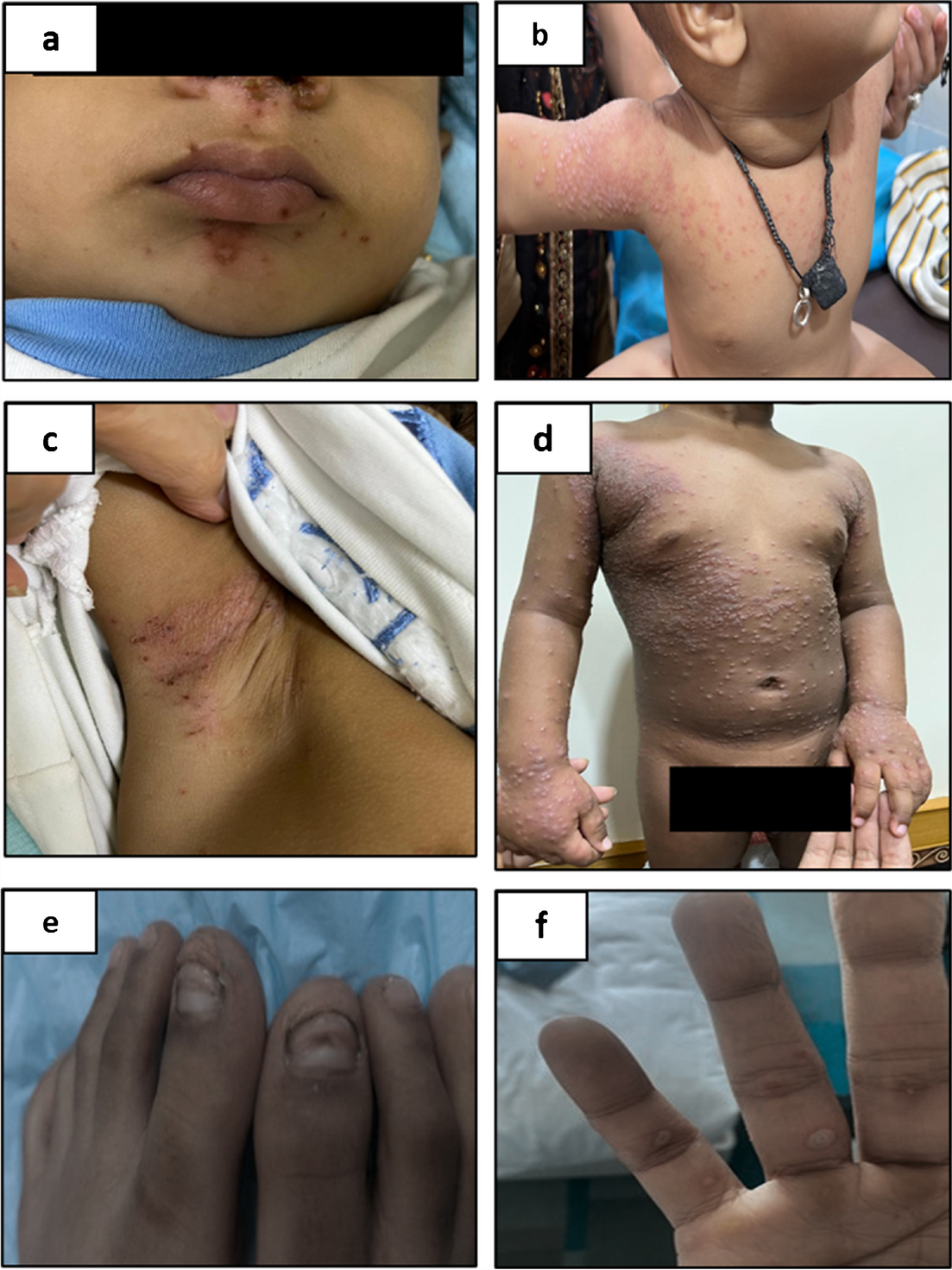 Enteroviruses Associated with Hand Foot and Mouth Disease in Navi Mumbai, Maharashtra, India in 2022