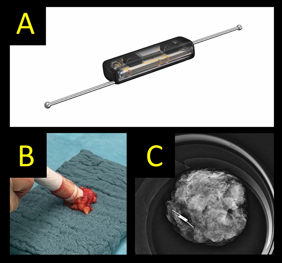 Radar reflectors for marking of target lymph nodes in initially node-positive patients receiving neoadjuvant chemotherapy for breast cancer—a subgroup analysis of the prospective AXSANA (EUBREAST-03) trial