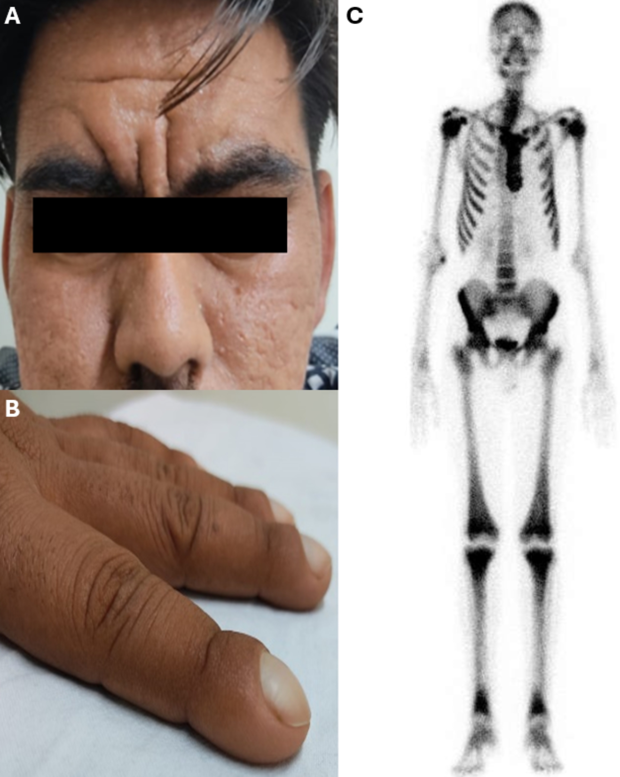 Myelofibrosis as a Presenting Manifestation of Primary Hypertrophic Osteoarthropathy