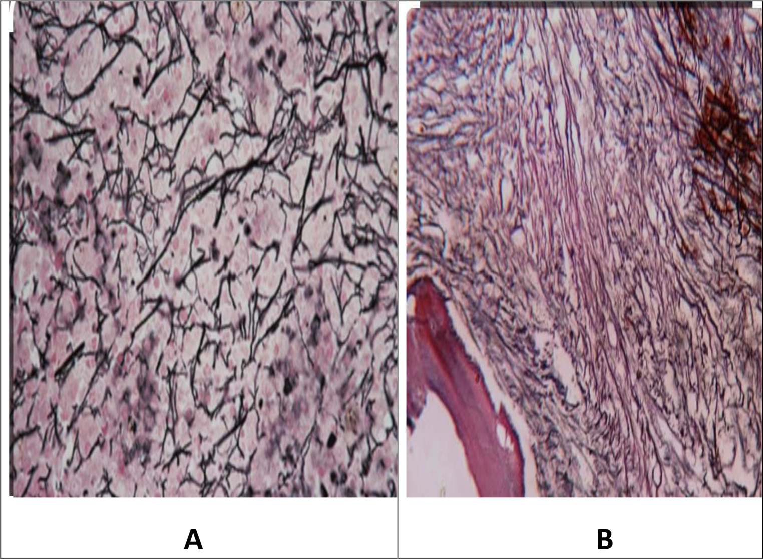 Impact of Bone Marrow Fibrosis on the Outcome of Chronic Myeloid Leukemia Treated with Second Generation Tyrosine Kinase Inhibitors