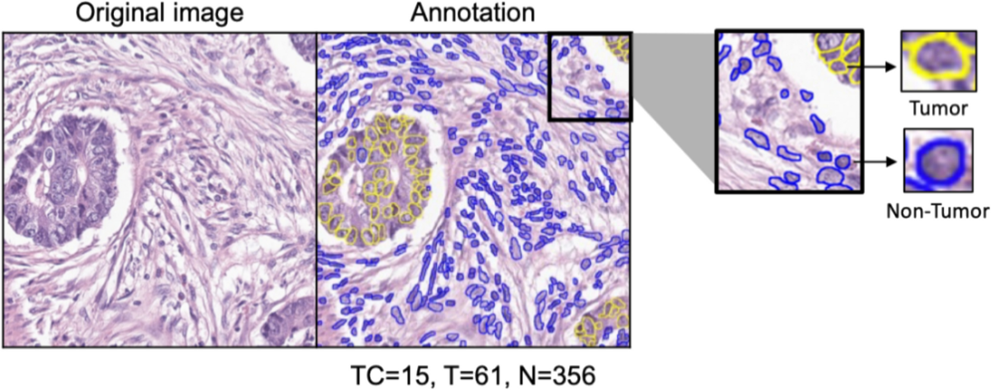 Boosting predictive accuracy in tumor cellularity evaluation with AI-powered ensemble methods