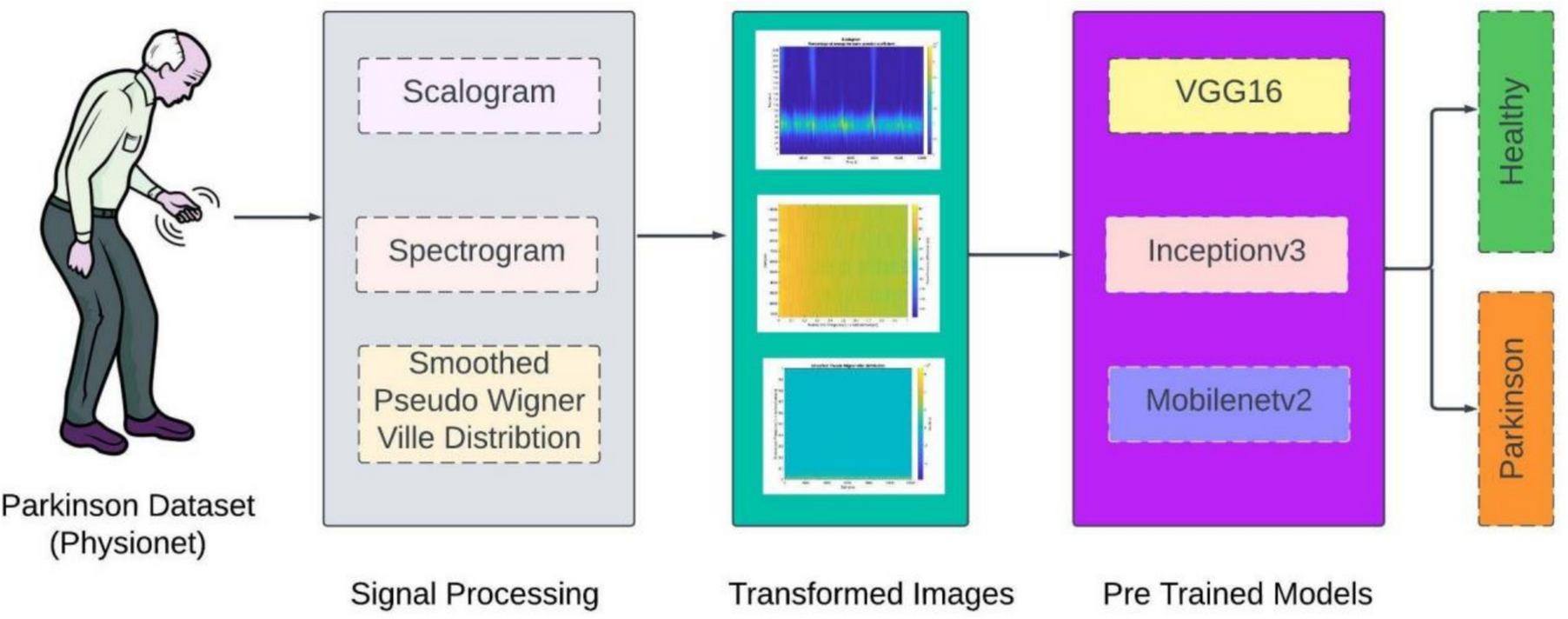 An efficient Parkinson's disease detection using smoothed pseudo-Wigner Ville distribution and MobileNetV2 convolutional neural network
