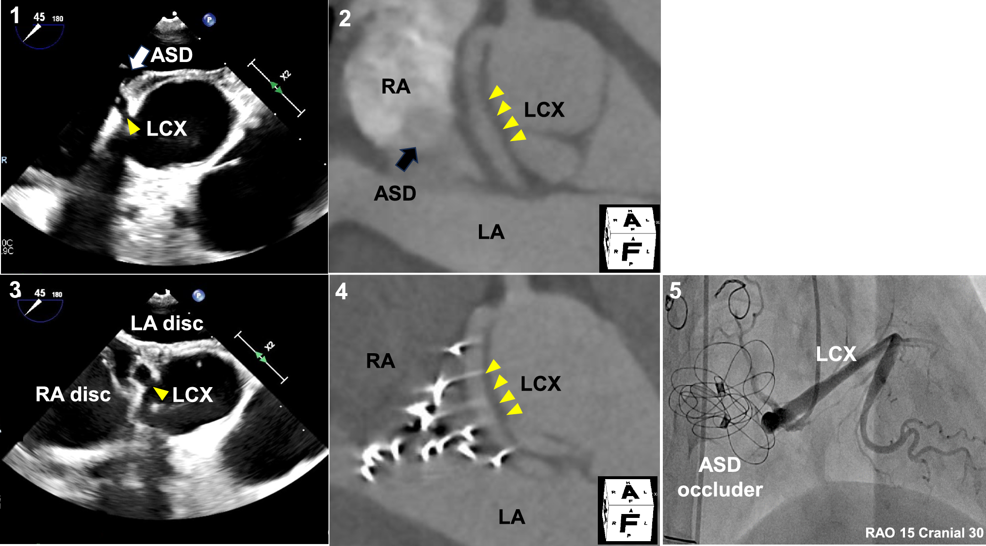 Successful transcatheter closure of atrial septal defect with gore cardioform atrial septal defect occluder in an adult patient with anomalous origin of left coronary circumflex artery
