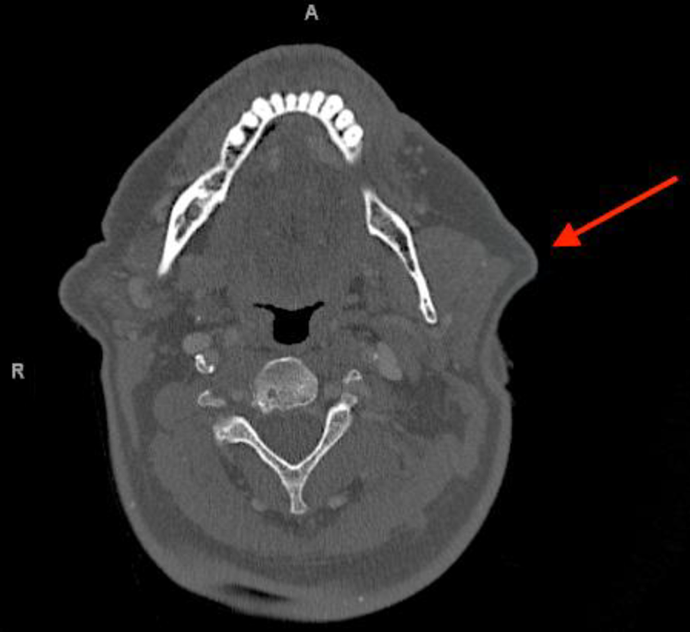 Mucoepidermoid Carcinoma Associated with an Intercalated Duct Lesion: Precursor or Coincidence?