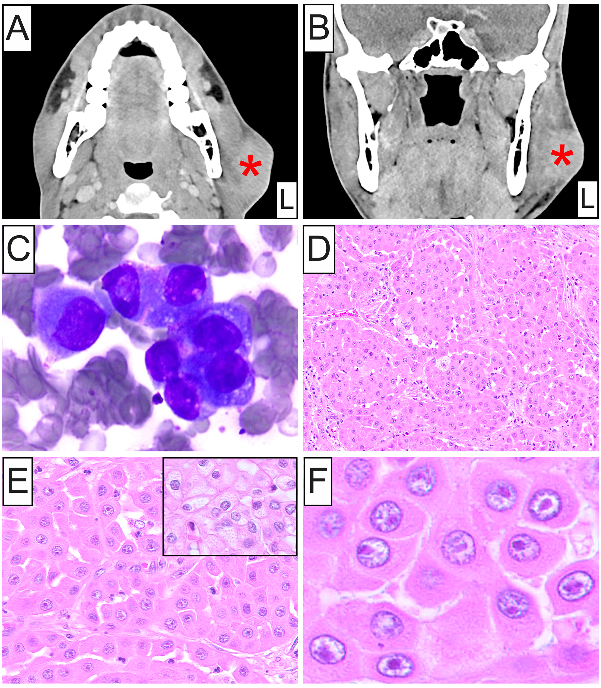 Oncocytic Mucoepidermoid Carcinoma of the Parotid Gland