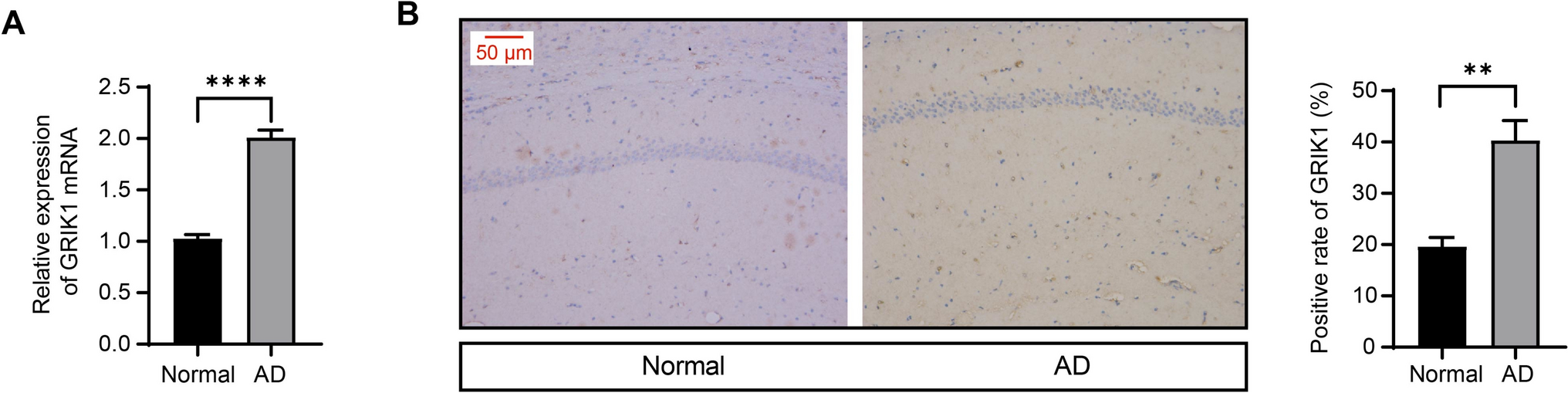 SP3-Mediated Transcriptional Activation of GRIK1 is Involved in Alzheimer’s Disease-Induced Cognitive Decline by Inducing Inflammasome Activation in Microglia